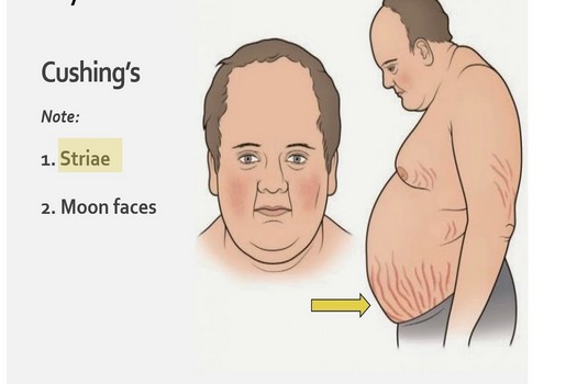 Cushings Syndrome Treatment In India Cost Hospitals And Doctor